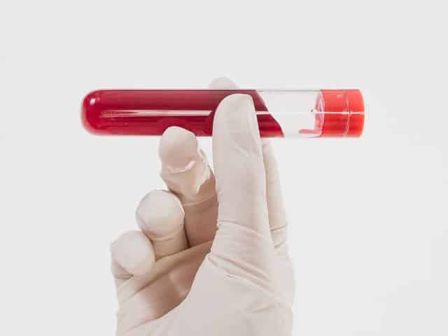 Badanie krwi – kiedy trzeba być na czczo, a kiedy niekoniecznie?