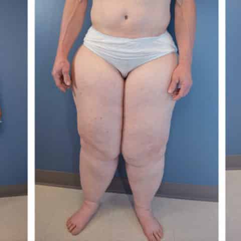 Lipodemia, czyli „choroba grubych nóg” – dietą tego nie wyleczysz